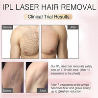 Ultrafast IPL Hair Removal Handset